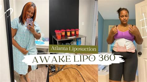 Awake Liposuction 360 Plus Bra Rolls Youtube