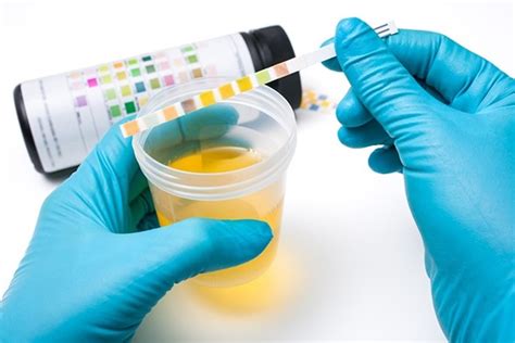 Urinalysis What Does An Urinalysis Test For How To Interpret Results