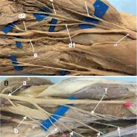 A A Median Nerve B1 First Branch From The Pronator Teres B2