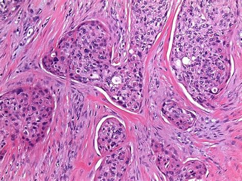 Moderately To Poorly Differentiated Squamous Cell Cancer Download