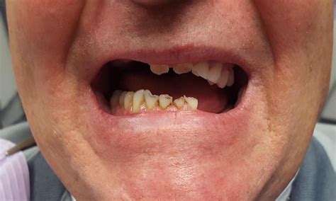 40 Pictures Of Partial Dentures Front Teeth Tommybraxton