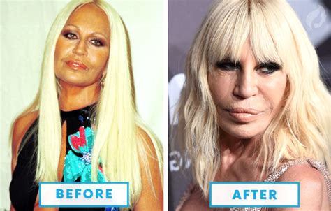 Celebrities With Bad Plastic Surgery Plastic Industry In The World