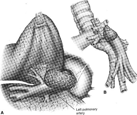 Combined Pulmonary Artery And Bronchial Sleeve Resection Operative