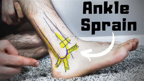 Sprained Foot Healing Time How Long And How To Speed It Up