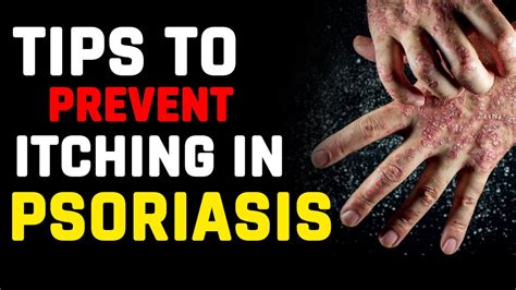 Tips To Prevent Itching In Psoriasis Psoriasis Tips Dr Megha