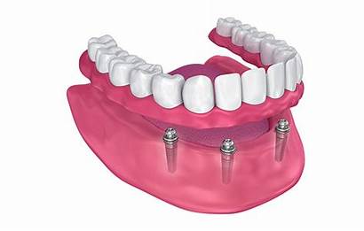 Dental Implants Arch Dentures Poster Nj Implant