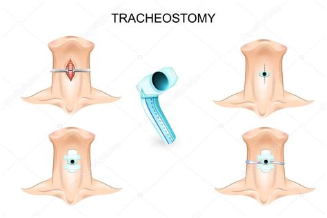 Pictures Tracheostomies Tracheostomy Tracheostomy Tube Stock