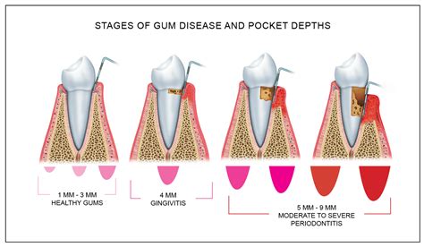 Gum Disease Treatment Hollywood Dental Group Yulia Nikoghosyan