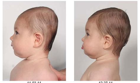 The Baby With A Flat Head How To Reverse The Rising Tide Of