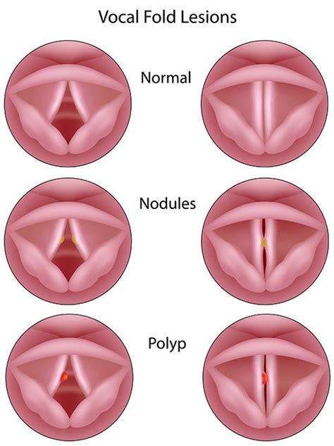 Vocal Cord Papilloma Symptoms And Effective Treatment Methods Papillomas