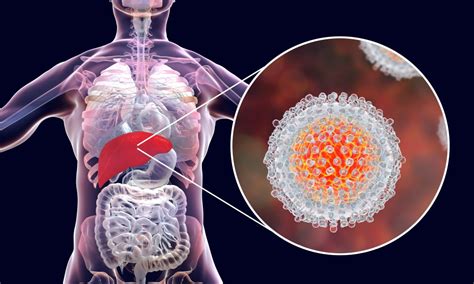 Adenovírus é O Principal Suspeito Para Causa De Hepatite Aguda Em