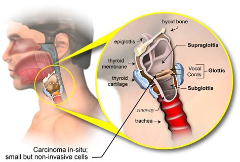 Staging Of Laryngeal Cancer American Head And Neck Society