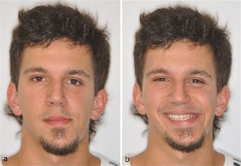 Facial Asymmetry Due To Occlusion How To Fix