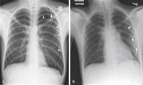 Thoracoscopy For Treatment Of Spontaneous Pneumothorax Abdominal Key