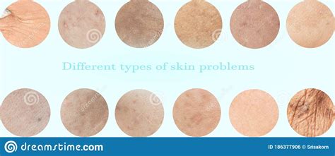 Different Types Of Skin Problems Stock Illustration