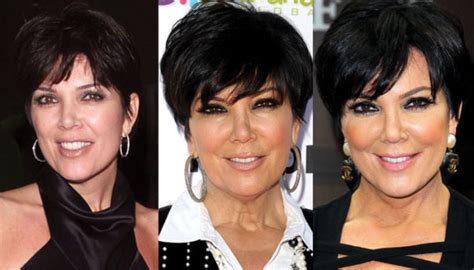 Kris Jenner Plastic Surgery Before And After Pictures 2024