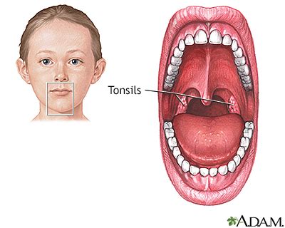 Tonsillectomy And Adenoidectomy Before And After