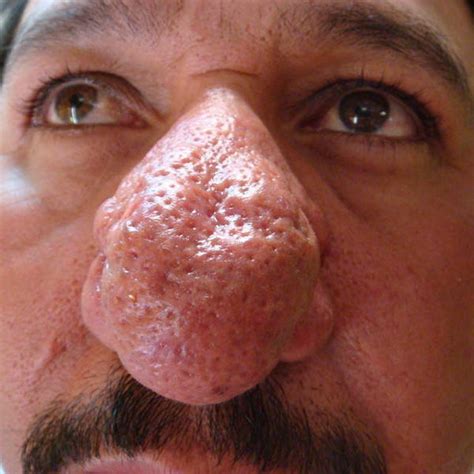 List 94 Wallpaper What Is A Purple Nose A Symptom Of Updated