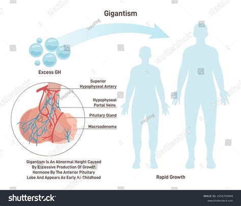 Gigantism Syndrome Characterized By Excessive Secretion Stock Vector