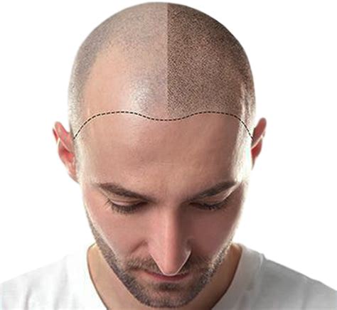 How Much Will My Scalp Micropigmentation Cost Maxim Smp
