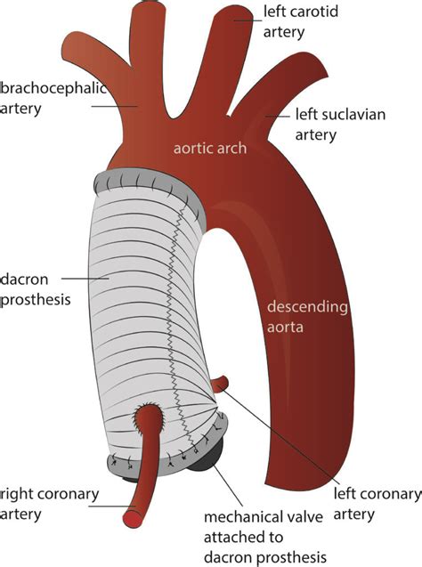 Aortic Surgery Kardiohirurgijars