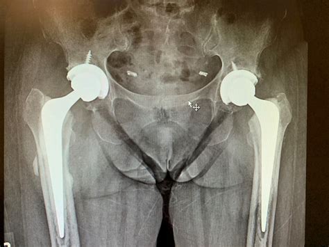 Case Study Bilateral Hip Replacement In 66 Year Old Female