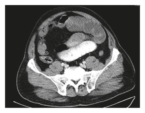 Abdominopelvic Ct Scan With An Intravenous Contrast Agent Topogram A