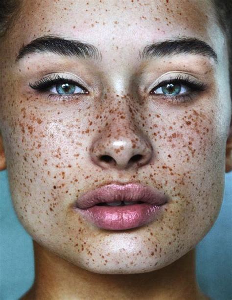 Whats The Difference Between Freckles And Sun Spots Center Aesthetic