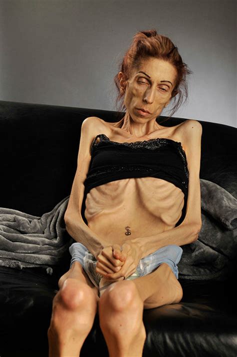 Photos California Woman Rachael Farokh Describes Her Shocking Descent Into Anorexia Abc Chicago