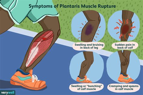 Plantaris Muscle Tears And Calf Pain