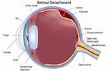 Treatment For Hole In Retina Of Eye Images