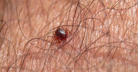 Lyme Disease What To Do If You Get A Tick Bite And Why You Need It