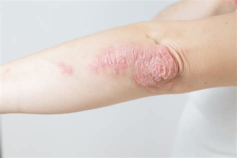 What Is Psoriasis Fatty Liver Disease