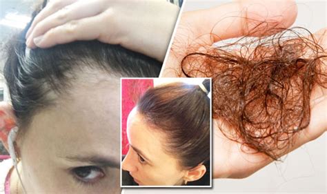 Hair Loss Cure Breakthrough Treatment Found By Woman Who Lost Hair