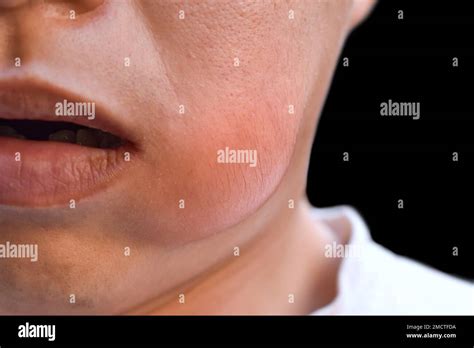 Swelling At The Cheek Of Asian Young Man Abscess Formation Stock Photo