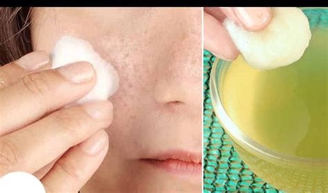 Home Remedies For Melasma Top 10 Home Remedies