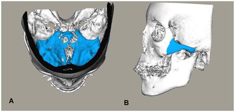 Anatomic Structures Used For Registration Highlighted On 3d Cbct