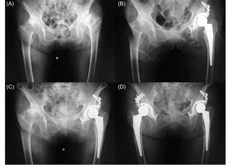A Osteoarthritis Of The Bilateral Hip B Immediate Post Operative
