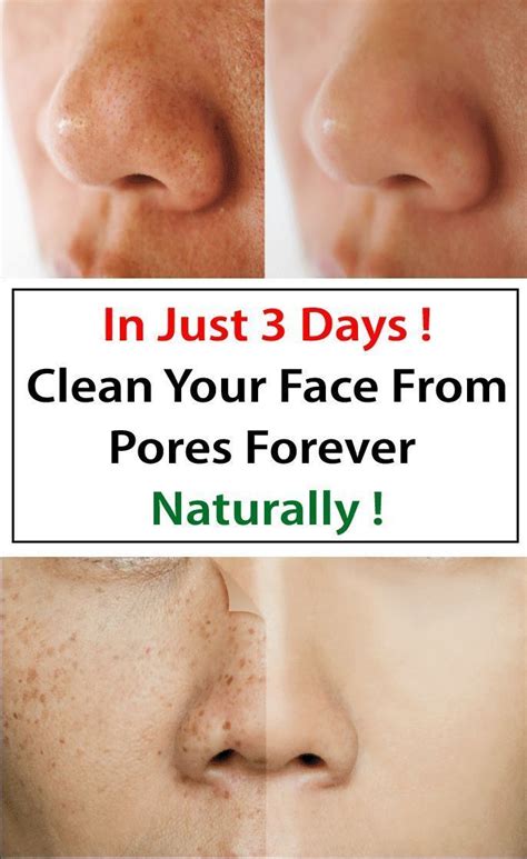 How To Make Pores Disappear With Only 1 Ingredient