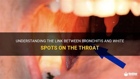 Understanding The Link Between Bronchitis And White Spots On The Throat