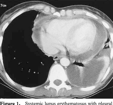 Figure 1 From Thoracic Manifestations Of Systemic Autoimmune Diseases