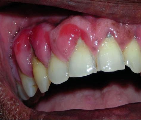 Oral Manifestations Of Hiv Case Studies Directorio Odontológico