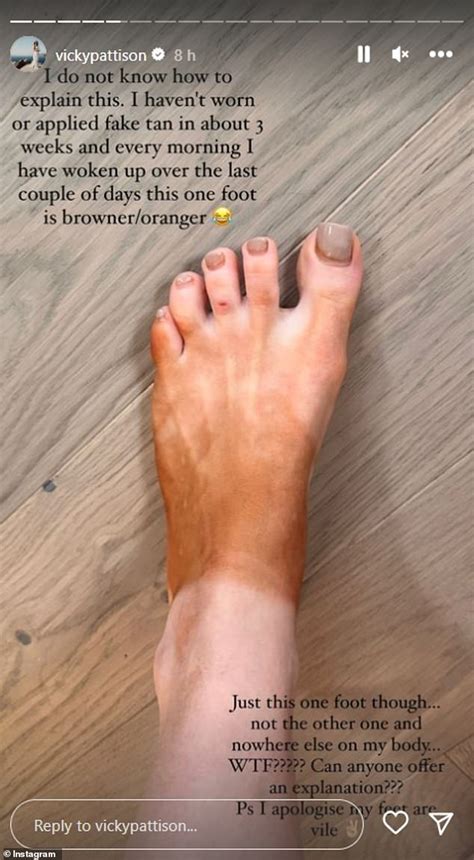 Vicky Pattison Shares Hilarious Snaps Of Her Bright Orange Foot As She Pleads With Fans For Help