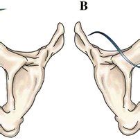 The Different Surgical Approaches To Mid Urethral Sling Placement A Download Scientific