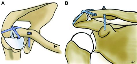 Schematic Representation Of The Final Coracoclavicular And