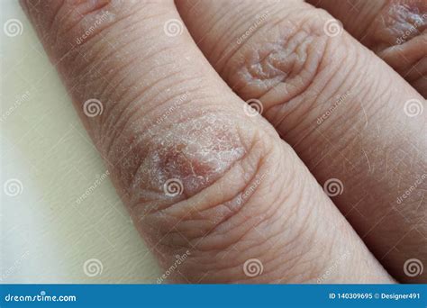 Close Up Of Hands With Dry Cracked Skin Stock Image Image Of Human