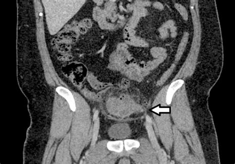 Diagnostic Imaging Of Acute Abdominal Pain In Adults Aafp