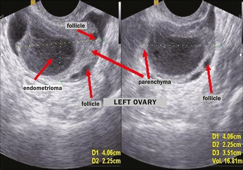 Scielo Brasil Transvaginal Ultrasound In Deep Endometriosis