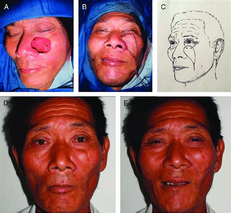 Case 1 A Midfacial Skin Defect Immediately Following Basal Cell