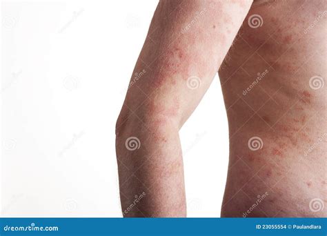 Psoriasis On The Body Stock Images Image 23055554